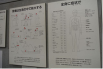 水俣病は神経を介して全身に広がり、さまざまな症状を見せる